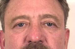 Blepharoplasty (Eyelid Surgery) patient result