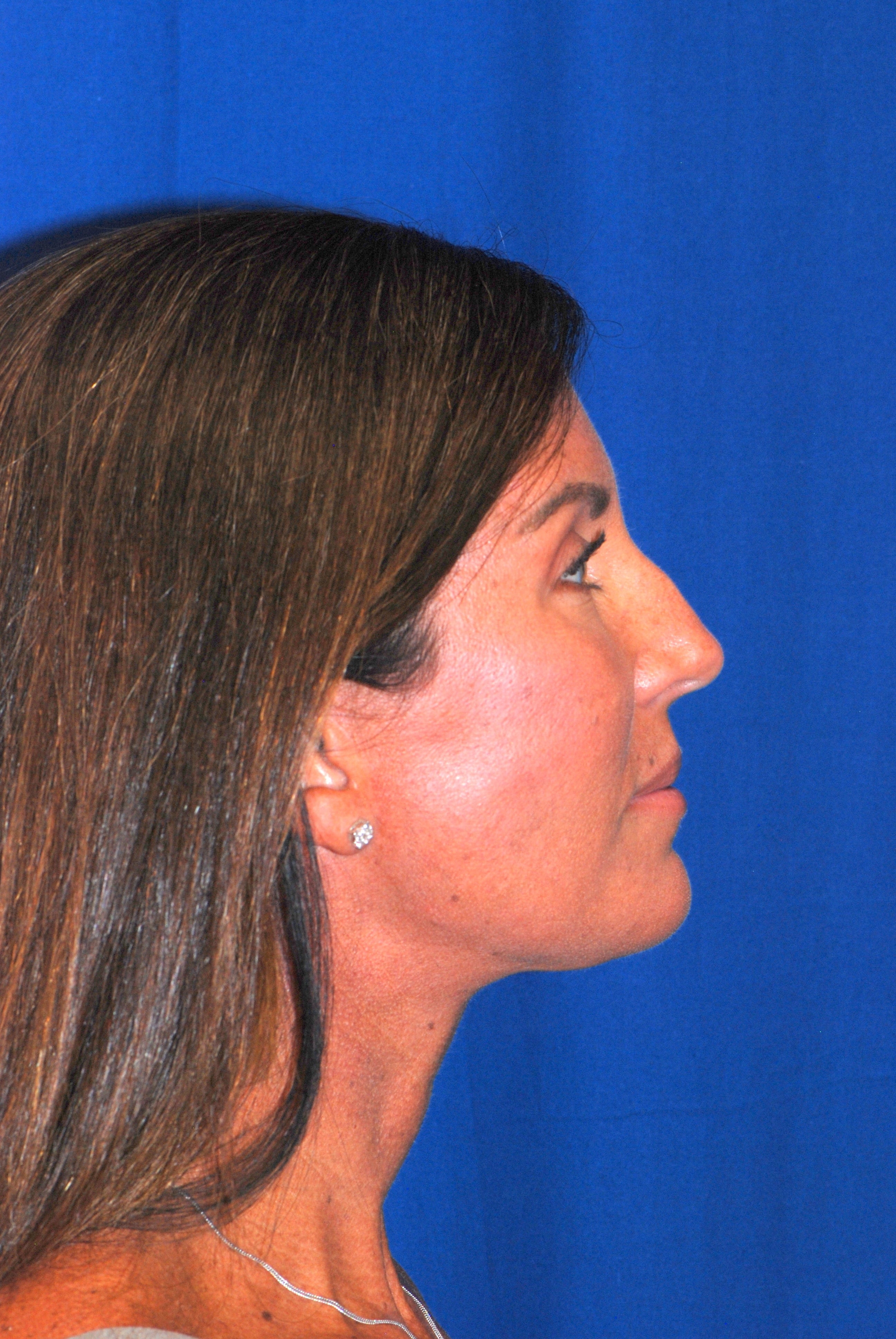 Facelift patient result