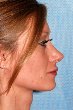 Lip Augmentation patient result