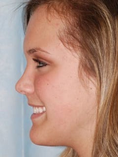 Orthognathic Surgery patient result