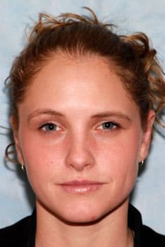 Otoplasty patient result